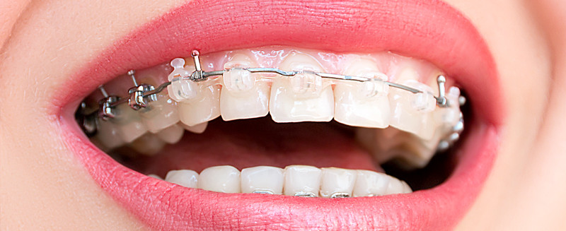 Cuándo es necesario llevar ortodoncia y cuándo es solo una cuestión estética
