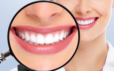 ¿Puedo comer de todo después de un blanqueamiento dental?